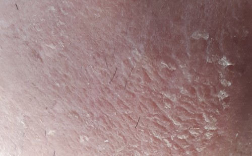 Twarz po intensywnej ekspozycji na promienie słoneczne - powrót do normalnego stanu skóry po 2 dniach aplikacji serum