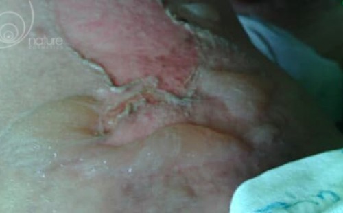 Uszkodzenie skórne po oparzeniu gorącą wodą - regeneracja 14 dni aplikacji serum