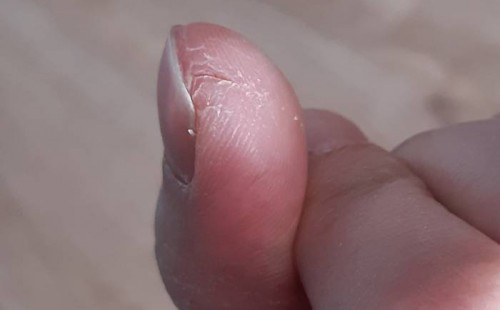 Nieustannie pękająca skóra w miejscu szycia palca - efekt stosowania serum ze śluzem 5 dni