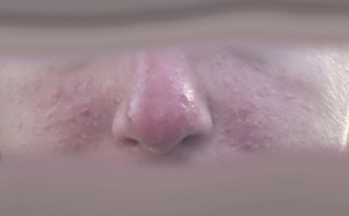 Trądzik różowaty i łojotokowe zapalenie skóry - efekt po 1,5 mc aplikacji serum