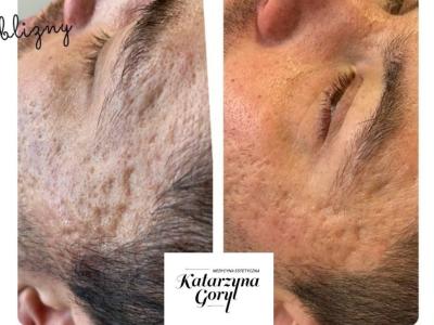 Efekty po 3 tygodniach, po 1 zabiegu mikronakłuwania skóry dermapenem z użyciem Ampułki Healthy Skin + dodatkowo codzienna pielęgnacja w domu Serum Healthy Skin